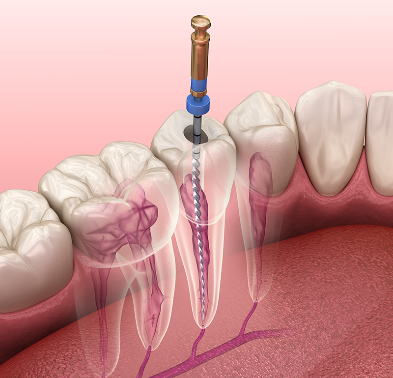 Root canal treatment illustration