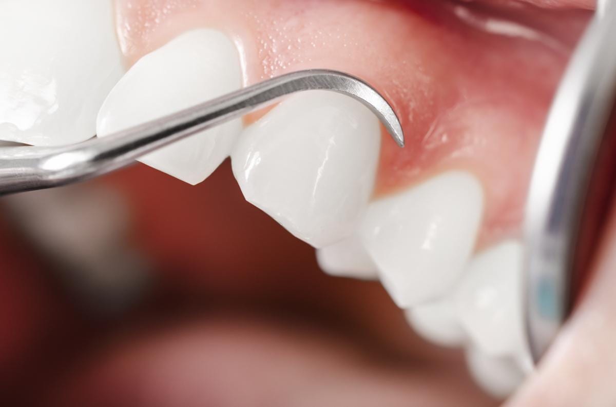 Periodontal gum treatment exam