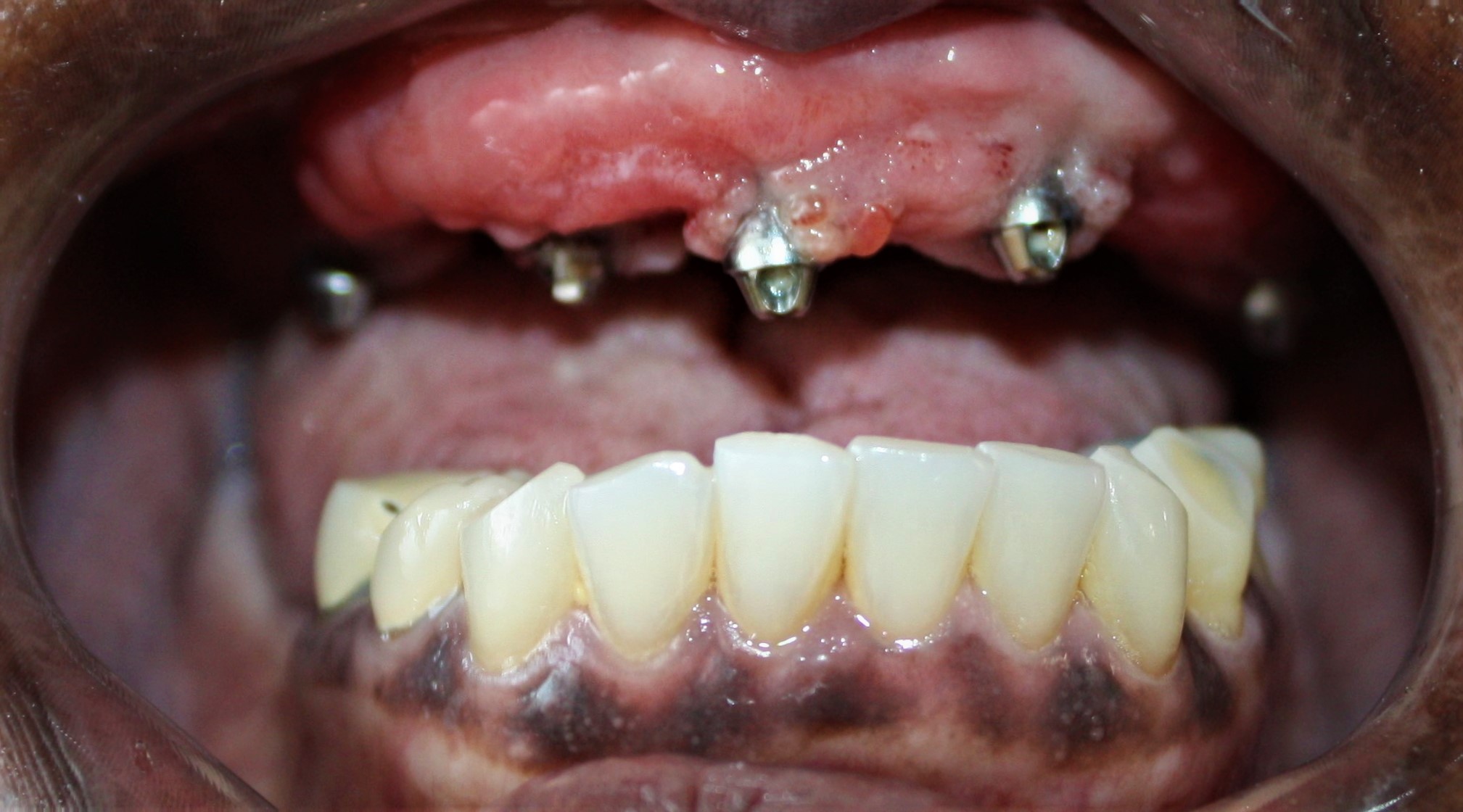 Implant patient - smile result at ImplantArt Tijuana