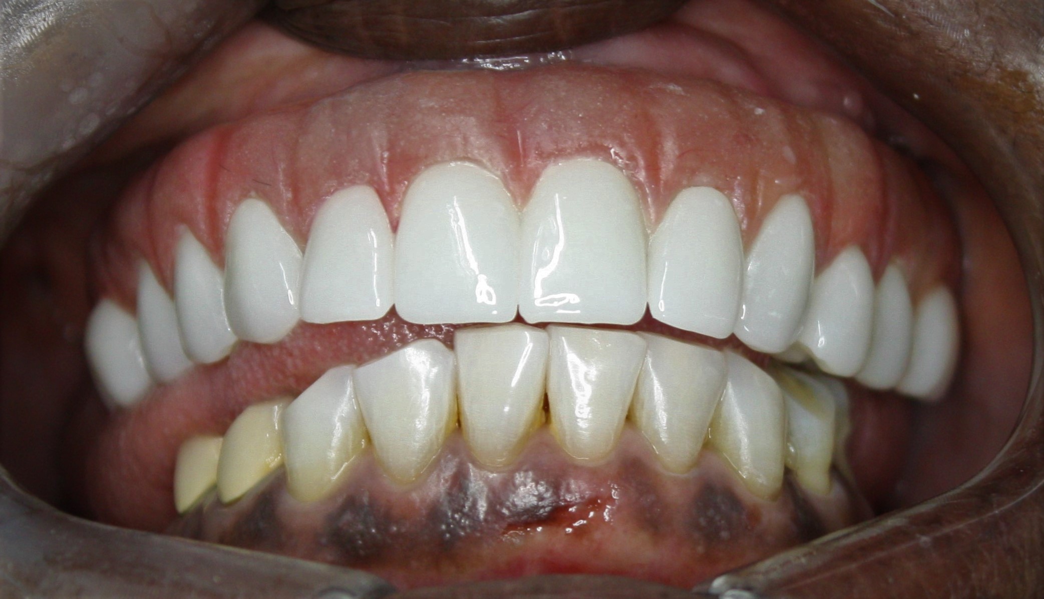 Implant patient - full-mouth result at ImplantArt Tijuana