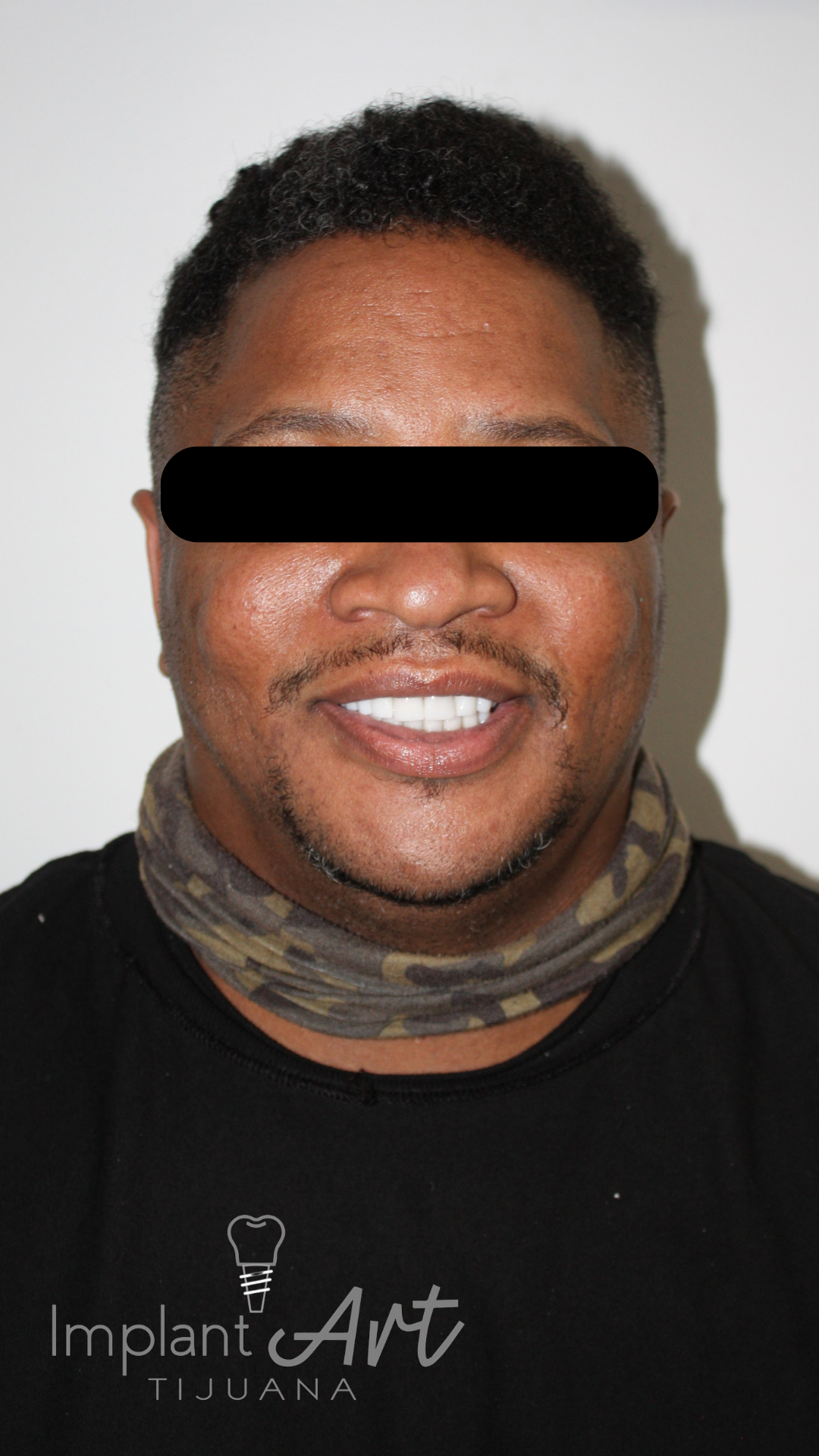 Patient smile after zirconia crowns and root canals