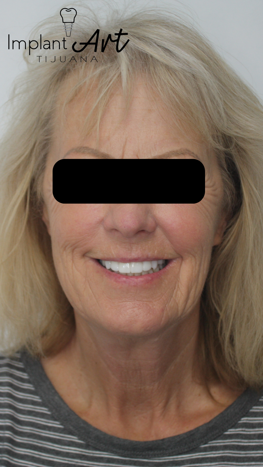 Patient smile after a 7-unit zirconia bridge on 3 implants