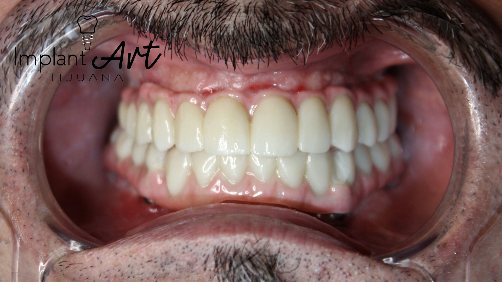 All-on-4 case - new smile at ImplantArt Tijuana