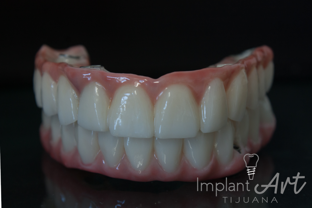 Pair of full-arch zirconia implant bridges