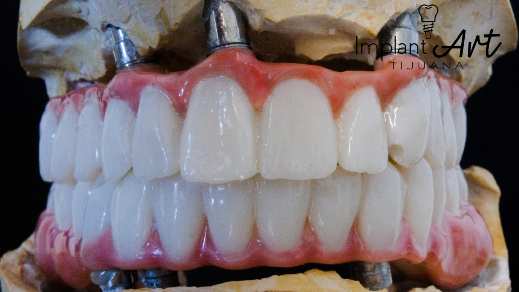 Upper and lower All-on-4 bridges on implants