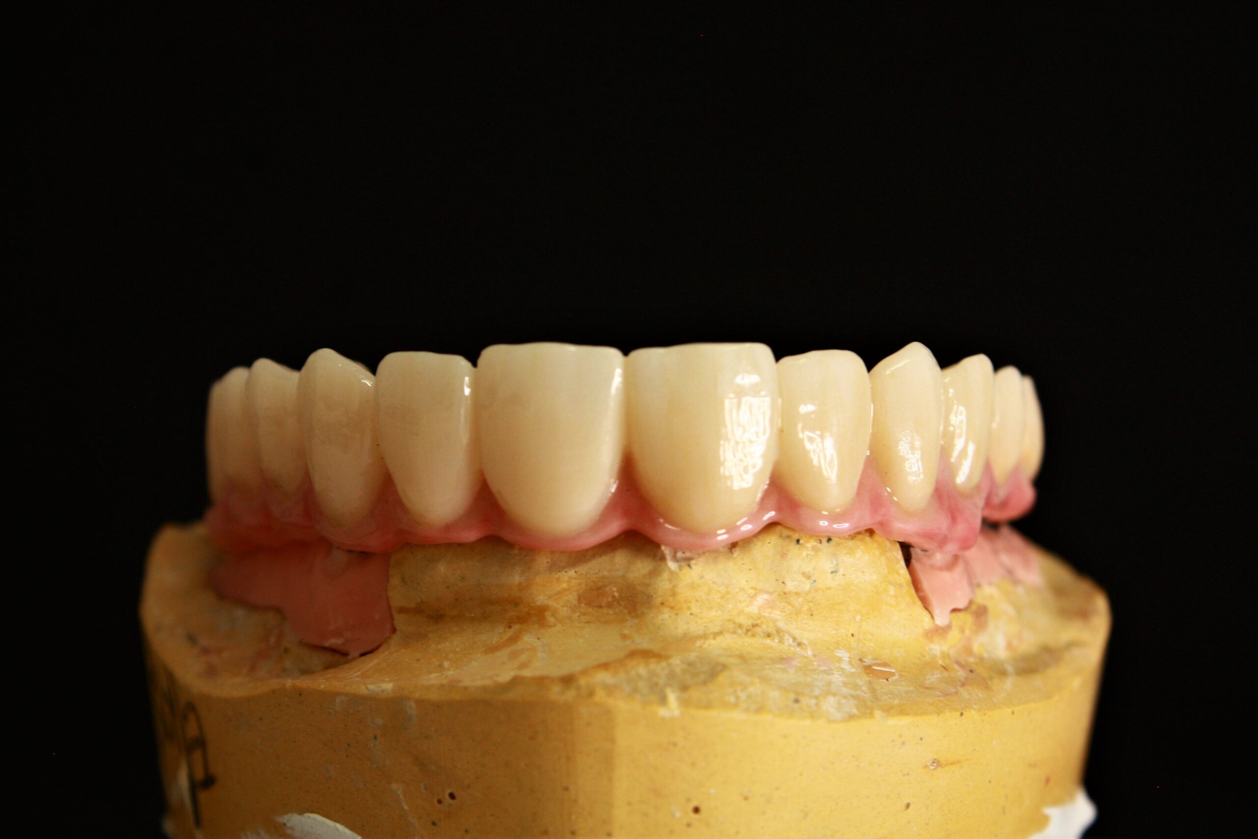 Zirconia implant bridge on a dental lab model