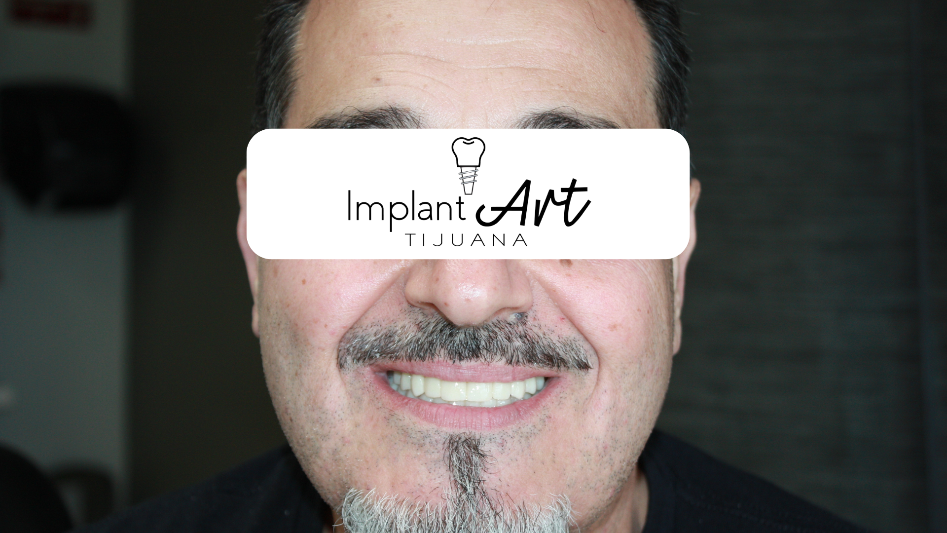 All-on-4 case - after treatment at ImplantArt Tijuana