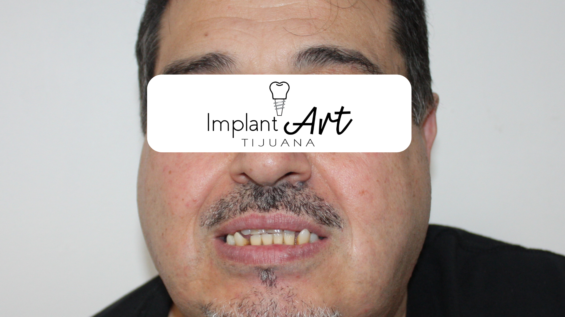 All-on-4 case - before treatment at ImplantArt Tijuana