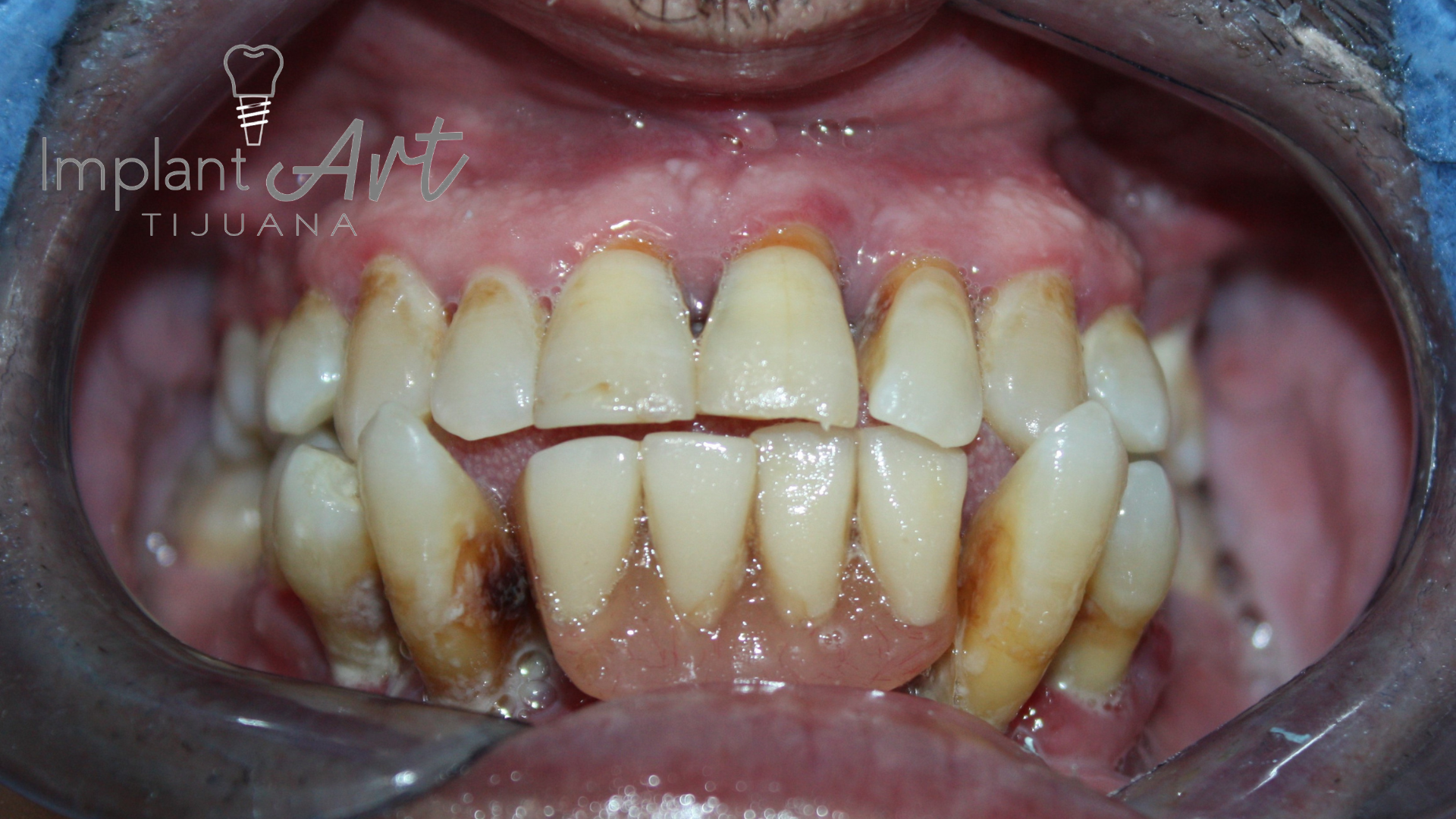 All-on-4 case - full-arch bridge at ImplantArt Tijuana